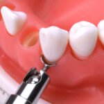 Ручка з насадками для ретракції ясен